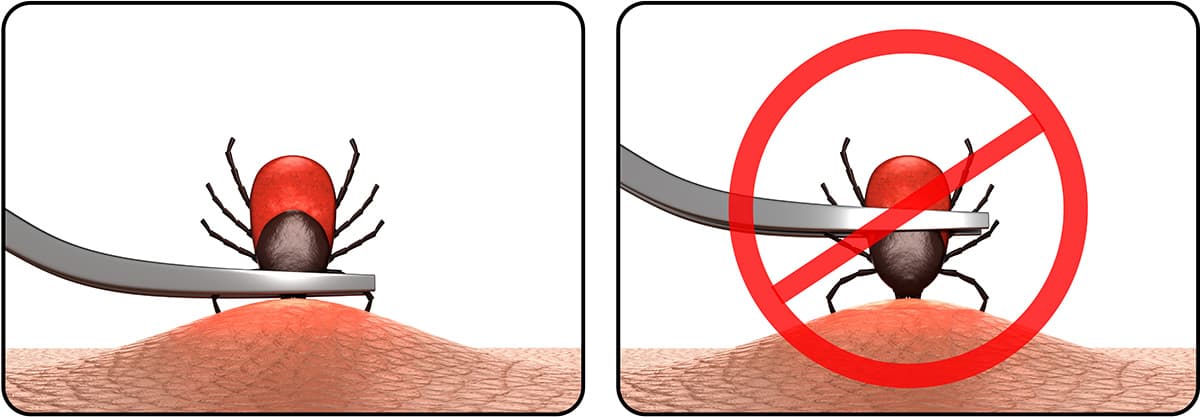 Zecke richtig entfernen: mit Zeckenzange hautnah fassen und gerade herausziehen